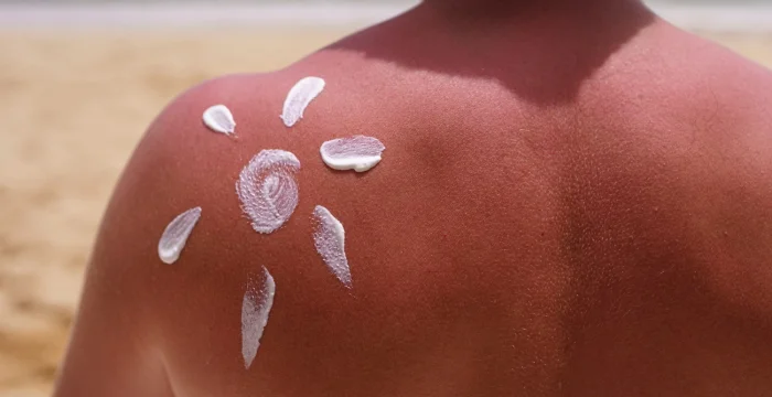 Eritema Solare Eritema Solare